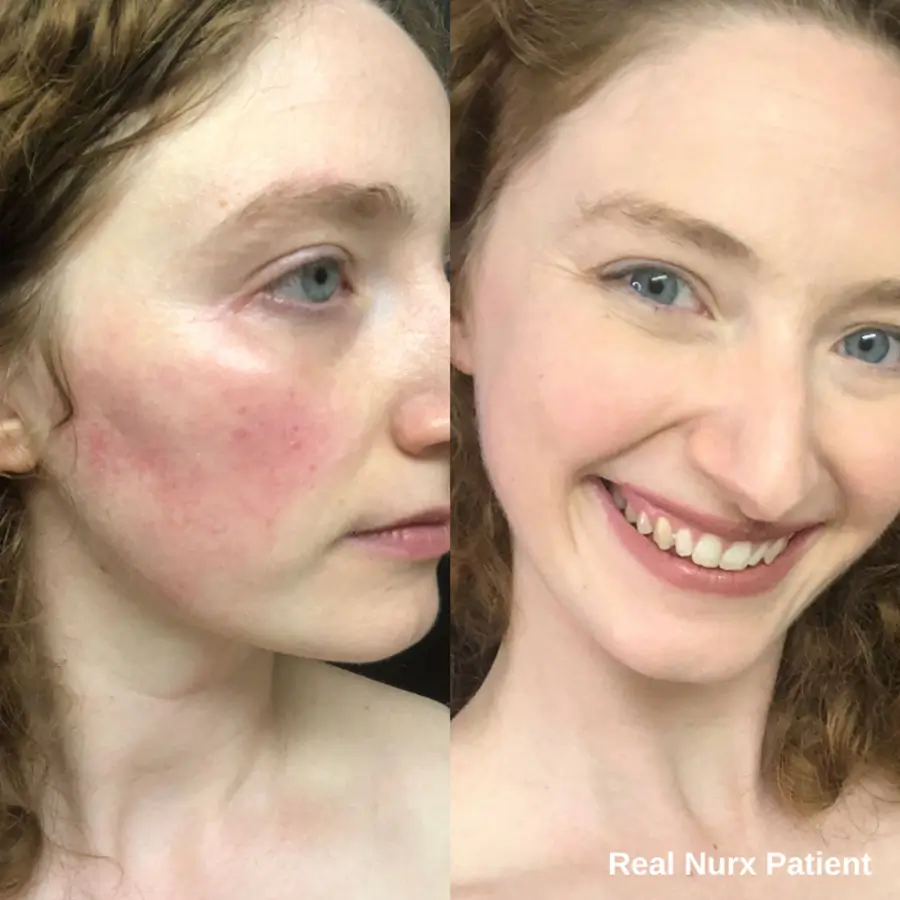 azelaic acid rosacea before and after